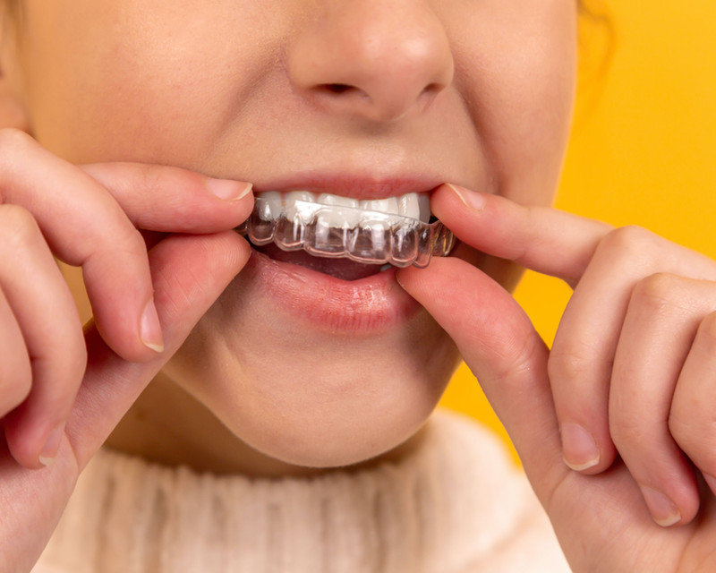 A clear aligner being placed over the teeth during a consultation discussion.