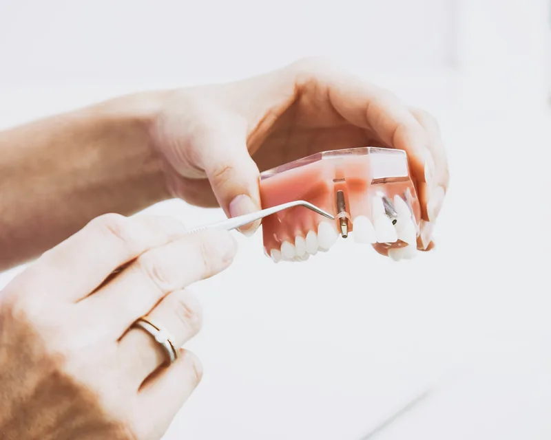 A dental implant model