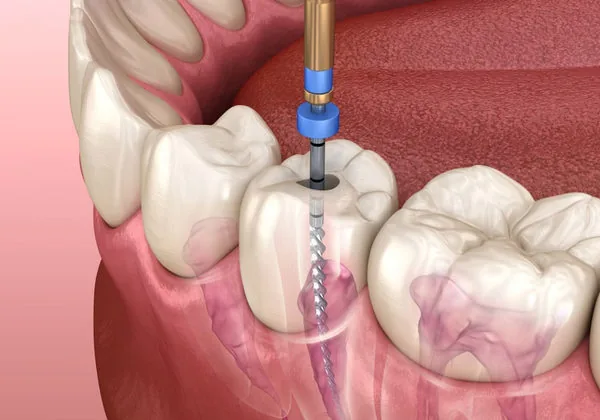 Root canal treatment