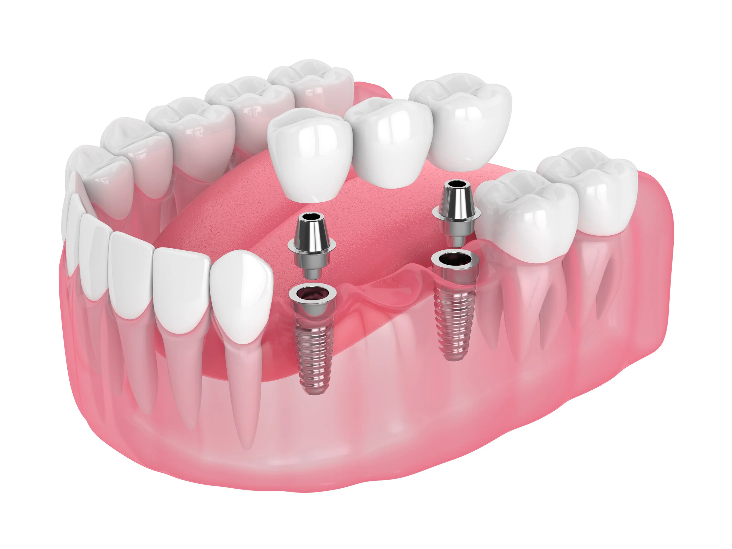 Illustration of an implant-supported bridge replacing several teeth.