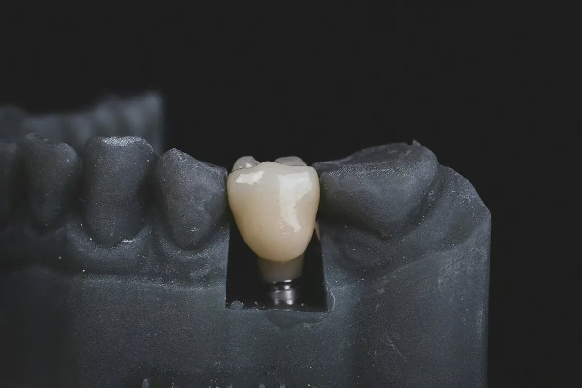 A finished implant crown seated on the implant in a dental model.
