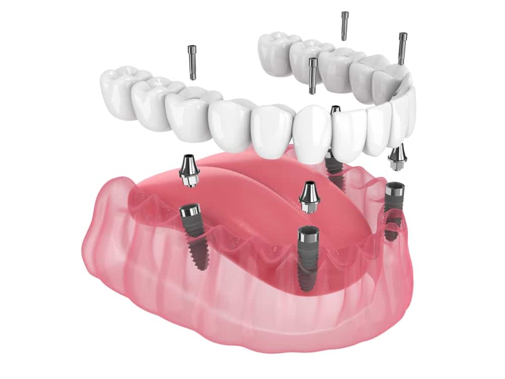 Illustration of a fixed full-arch All-on-4 (AOX) restoration supported by multiple implants.