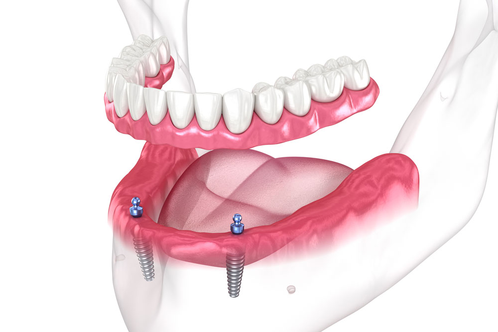 Illustration of a removable overdenture clipping onto two dental implants.