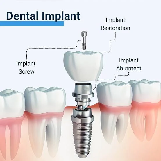 Diagram of a dental implant labelled with its parts: the implant screw, the abutment and the restoration that sits on top.