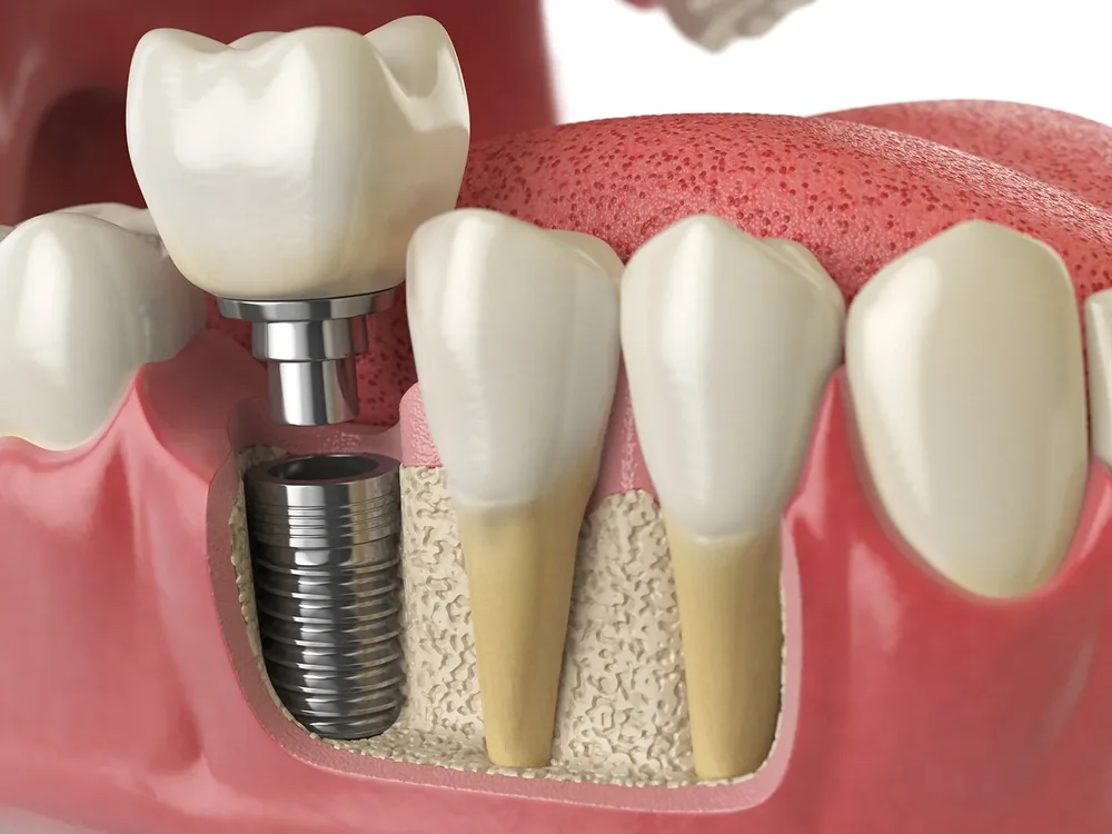 A single dental implant in the jawbone supporting one crown, shown beside the natural teeth either side.