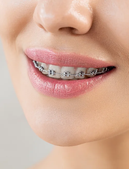 Tooth-coloured ceramic braces on the upper teeth