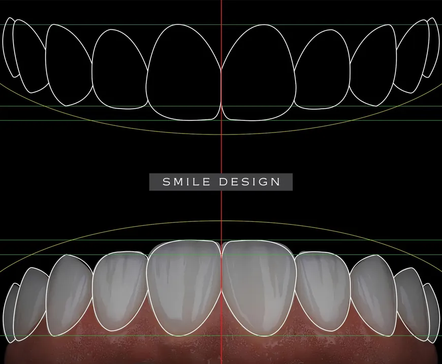 A digital smile design overlay mapping the planned position of each front tooth.